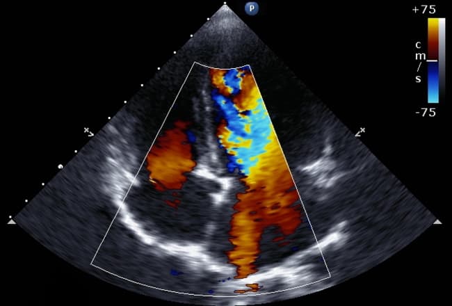 Ecocardiograma com Doppler colorido