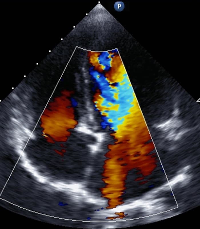 Ecocardiograma com Doppler colorido